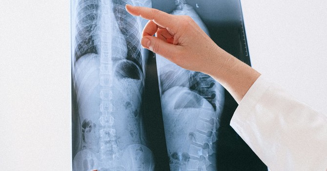 No, you don’t need X-rays…probably